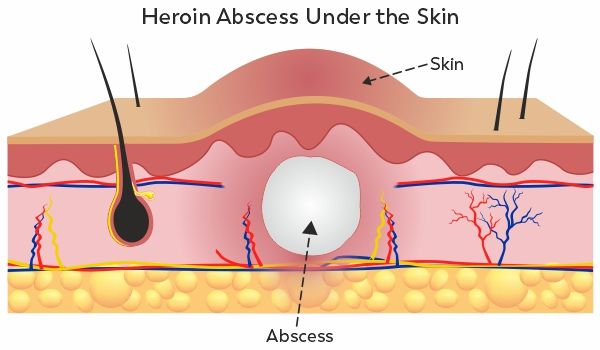 heroin and fentanyl abscesses forming