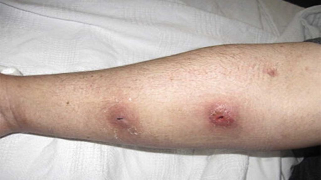 Early warning signs of abscesses from IV drug use